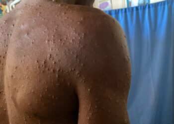 Mais dois doentes com mpox na Província de Maputo e cinco na Província do Niassa