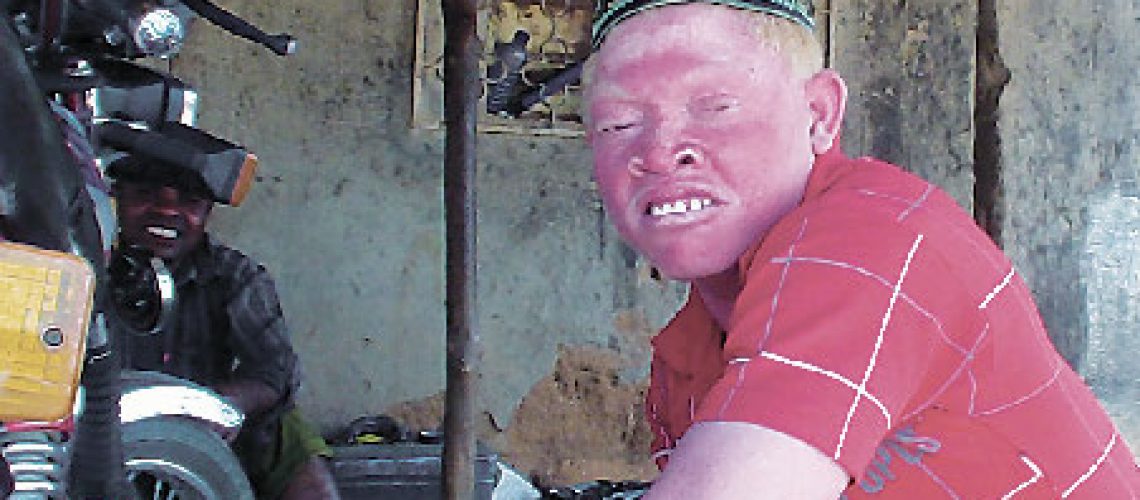 Jovem albino vive em pânico em Nampula